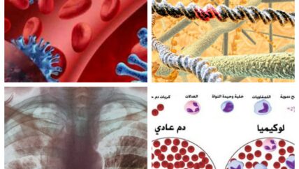 مرضى السرطان بالآلاف.. وعجز طبي مع غياب للأدوية في الشمال السوري