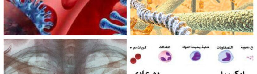 مرضى السرطان بالآلاف.. وعجز طبي مع غياب للأدوية في الشمال السوري