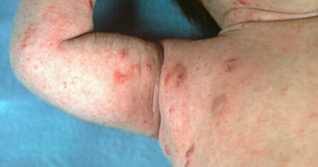 مكبات النفايات بؤرة أوبئة للمخيمات المجاورة