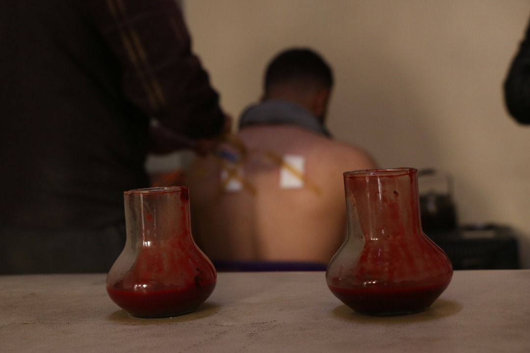 الدم الفاسد الذي يخرج من الشخص المحجوم -فوكس حلب