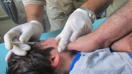 تشوهات جلدية نتيجة الإهمال والعلاج التقليدي لحبة اللشمانيا