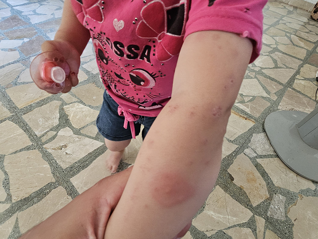 طفل مصاب باللشمانيا نتيجة انتشار البعوض حول مجرى نهر قويق جنوبي حلب.