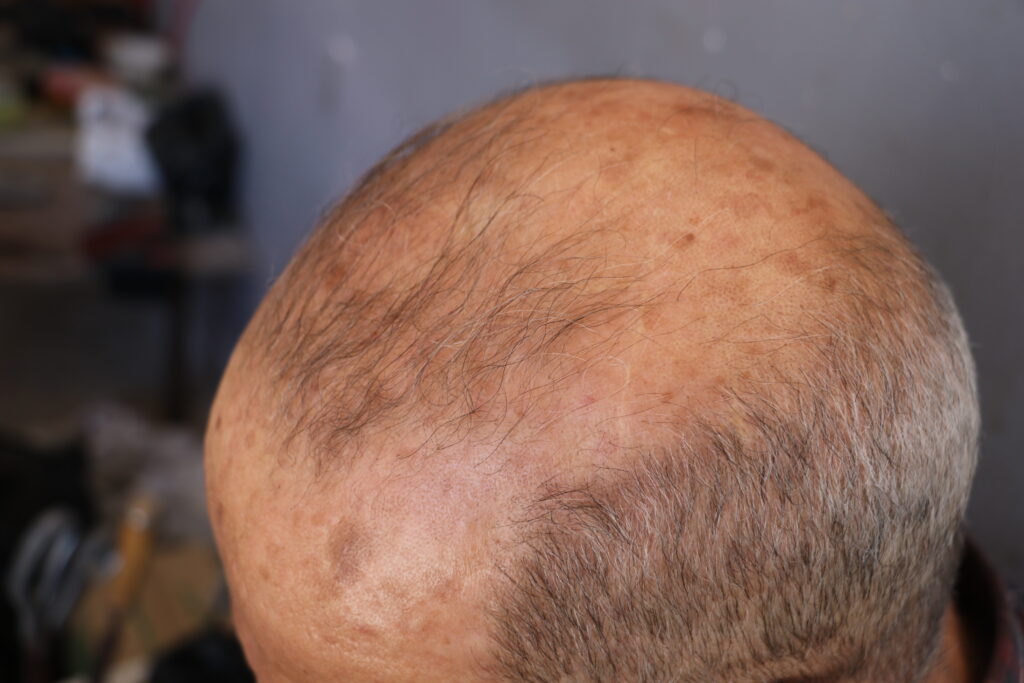 رأس أبو محمود عليه آثار التعذيب الذي تلقاه فترة اعتقاله. خربة الجوز، ريف جسر الشغور،  تشرين الأول 2025. تصوير: هيام الباشا