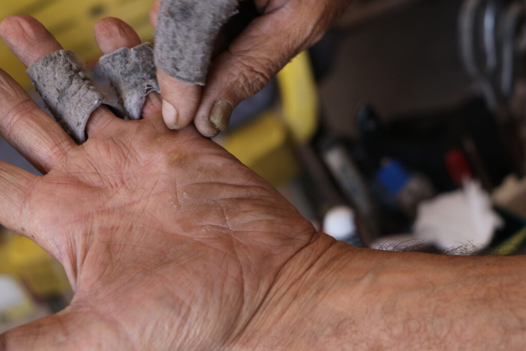 يد أبو محمود مصابة بمسامير لحم. خربة الجوز، ريف جسر الشغور، تشرين الأول 2025. تصوير: هيام الباشا