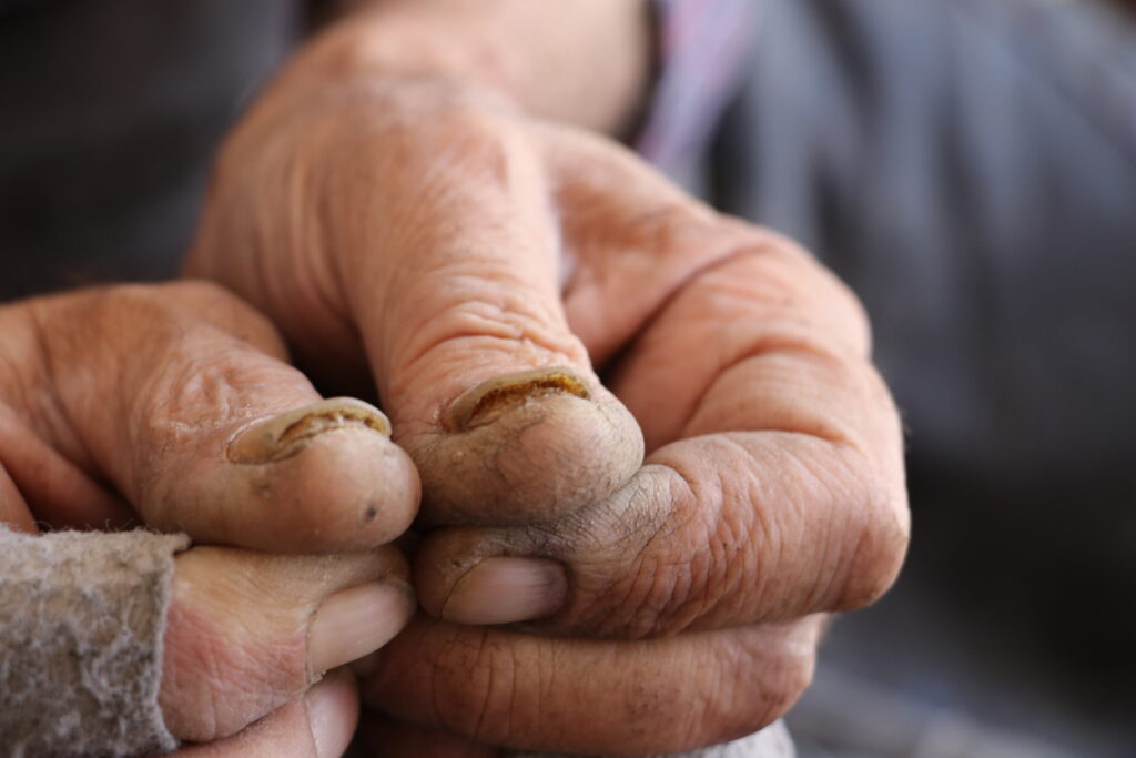 أصابع وأظافر أبو محمود المتأذيات بسبب استخدام أدوات العمل. خربة الجوز، ريف جسر الشغور، تشرين الأول 2025. تصوير: هيام الباشا