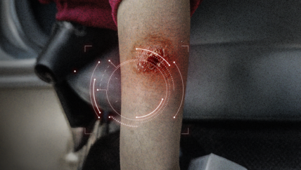 على طرقات ريف إدلب الجنوبي.. معركة يومية للحد من انتشار اللشمانيا